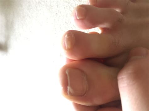 Can anyone tell me why my toenails look like this? It seems as if I