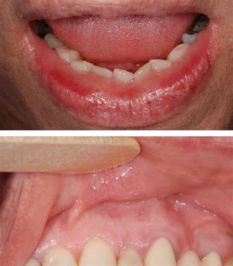 red spots    bottom lip infoupdateorg