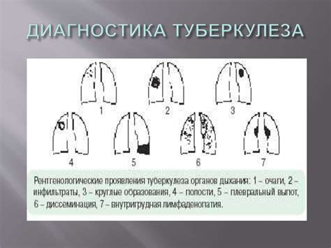 Туберкулез. Возбудитель туберкулеза - презентация онлайн