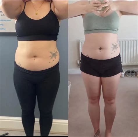 CoolSculpting Before and After - Before After Journey