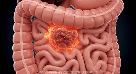 Sangramento No Intestino Sintomas - Câncer Colorretal: Entenda a Obstrução, o Sangramento e os Sinais de ...