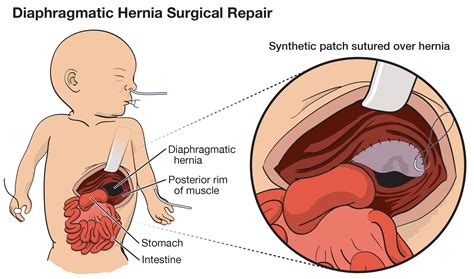Diaphragmatic Hernia 🫁 Congenital Diaphragmatic Hernia (CDH)