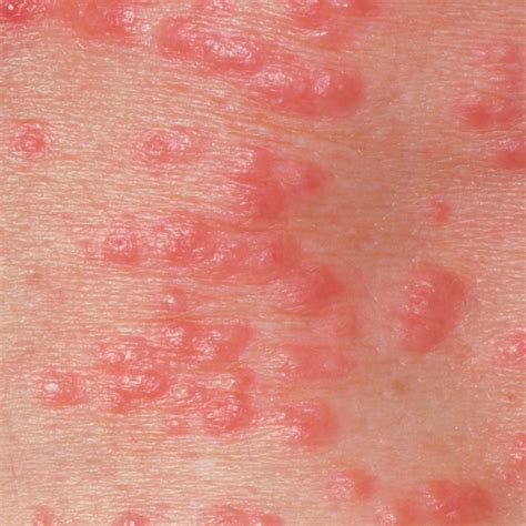 5 Types of Bug Bites - Causes of Bug Bite Rashes