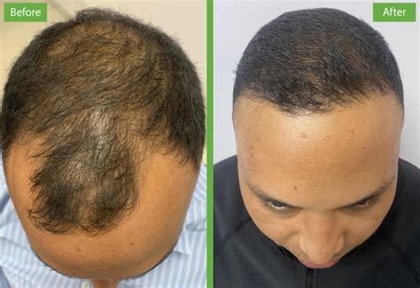 Hair Restoration in Nepal | Permanent Hair Loss Treatment