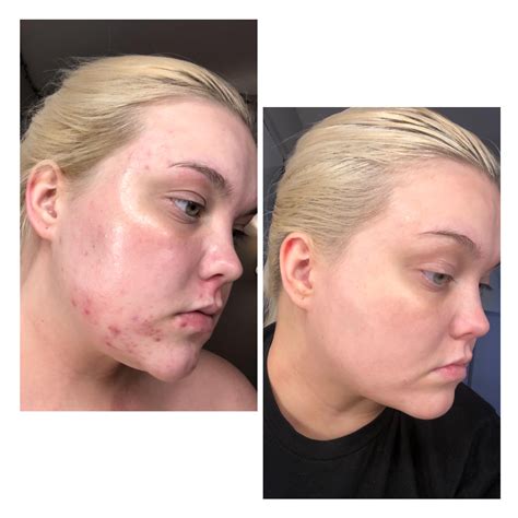 Azelaic Acid With Tretinoin 13