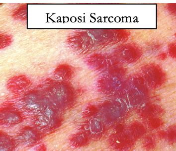 SS 13 - Sarcoma Flashcards | Quizlet