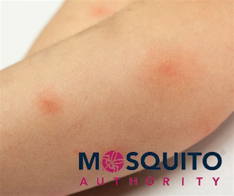 Mosquito Bite Allergic Reaction