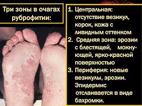 Микозы стоп - презентация онлайн