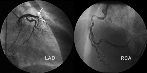 Case 1. Coronary angiogram shows a completely occluded LAD artery ...