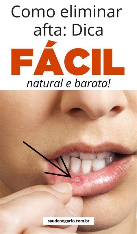 Como Eliminar Afta Na Boca - Como eliminar a afta na boca em 1 minuto! (Passo a Passo)