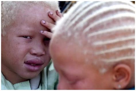 Skin cancer, vision loss, greatest challenges plaguing us – Albinism ...