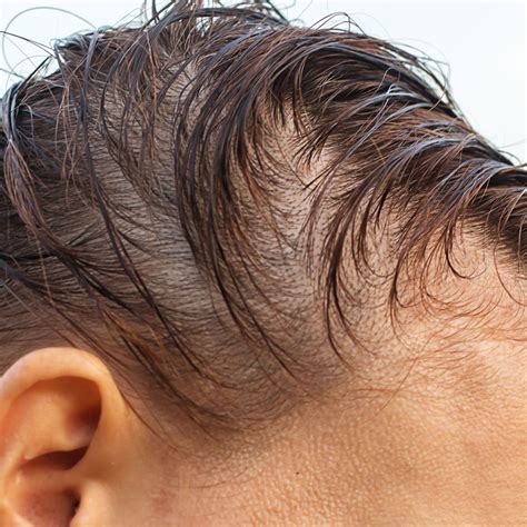 Can Taking Vitamin D Help with Hair Loss? | Ro