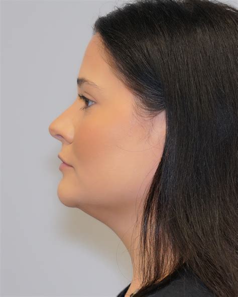 Before & After Photos - Augusta Plastic Surgery