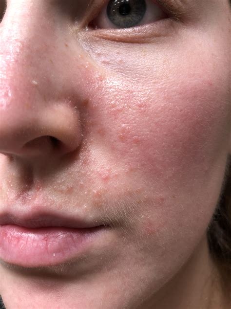 [Acne or Perioral Dermatitis Help] I developed these bumps all over my