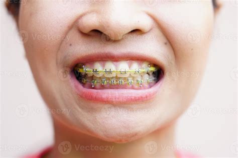 smiling asian woman have braces 7439139 Stock Photo at Vecteezy
