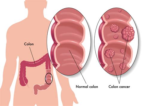 GI specialists explain what the tortous colon treatment entails 33
