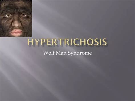 PPT - Hypertrichosis PowerPoint Presentation, free download - ID:2950350