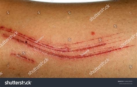 arm cuts images stock   objects vectors shutterstock