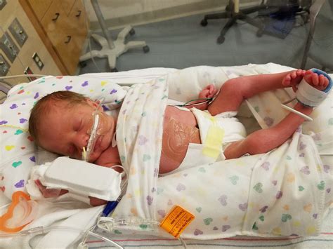 Baby Born With Spina Bifida