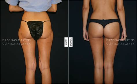 Lipo No Culote Antes E Depois - Lipoaspiracao Antes E Depois Lipoaspiração Antes E Depois: Fotos Do