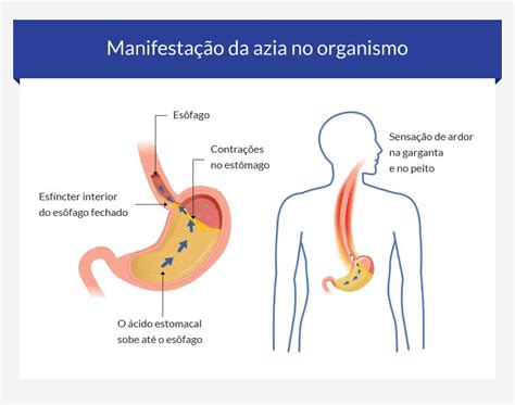 O Que Causa Azia E Queimação