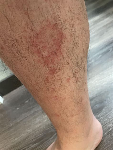 Bed bug bites? : r/DermatologyQuestions