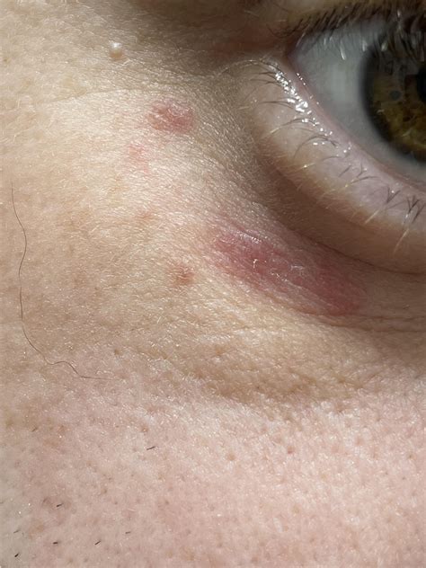 Acne? Eczema? Been under my right eye for at least a month now. | Scrolller