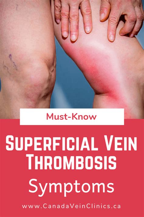 Superficial Venous Thrombosis