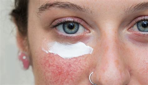 Redness around Nose Causes and How to Get Rid of Red, Dry Skin on Nose - American Celiac