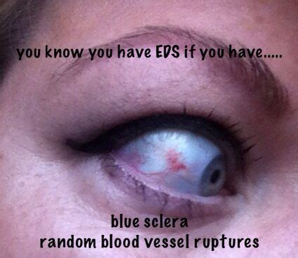 You know you have eds when...... #eds #ehlersdanlos #zebra #eye # ...