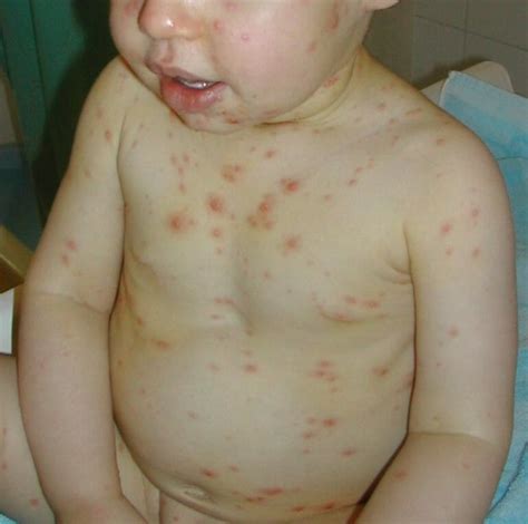 chickenpox  babies symptoms prevention treatment