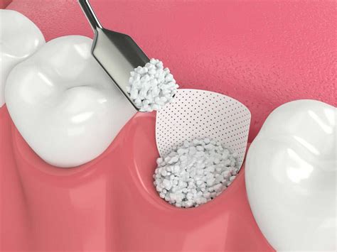 Dental Bone Graft - Bone Graft for Dental Implant