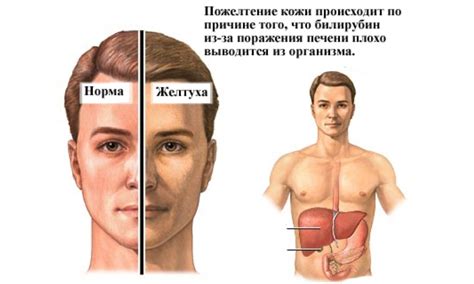 Желтуха - признаки, причины, симптомы, лечение и профилактика - iDoctor.kz