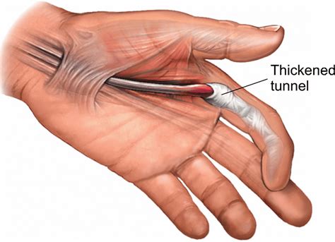 trigger finger definisi penyebab gejala  tata laksana ai care