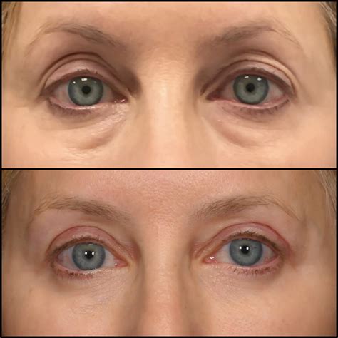 Upper Blepharoplasty Before & After Photos | Flora Levin MD
