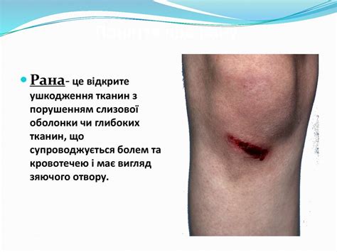 Рани. Характеристика ран. Перша допомога при поранені - презентация онлайн