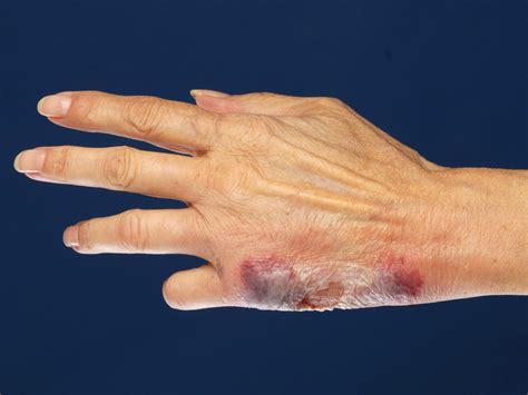 Neutrophilic Dermatosis
