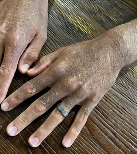 Man's skin turns black from reaction to antidepressant Prozac