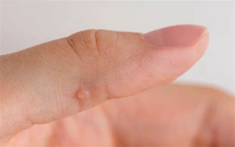 warts medical offices  manhattan