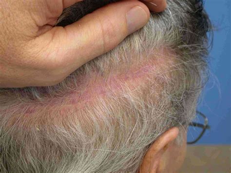 Shock Loss After Hair Transplant | Causes And Duration