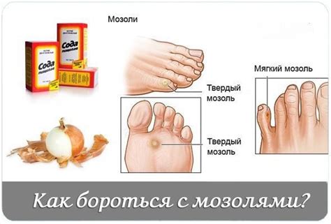 Как бороться с мозолями. Народные советы