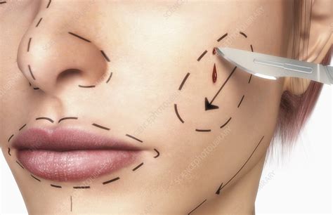 Rhytidectomy - Stock Image - F002/4077 - Science Photo Library