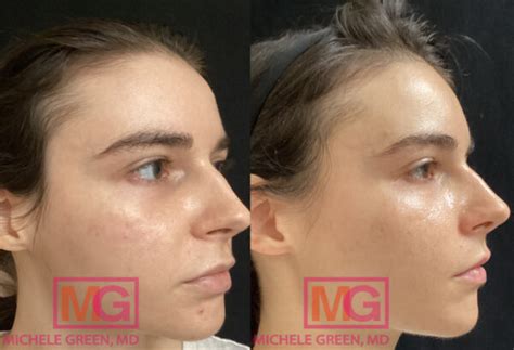 Sculptra Jawline - Dr. Michele Green M.D.