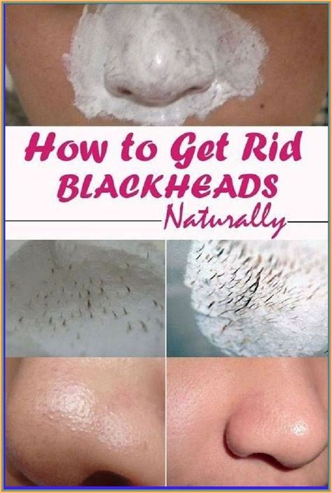 Unbelievable Blackhead Removal 2024: Get Rid of Blackheads for Good! - 6ecppbw