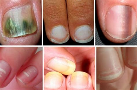 Unhas Arroxeadas O Que Pode Ser - Unhas arroxeadas podem ser sinal de doenças graves ocorrendo no corpo