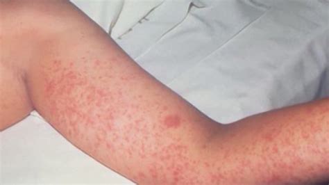 CVS Health offers measles vaccines in Arkansas | 5newsonline.com