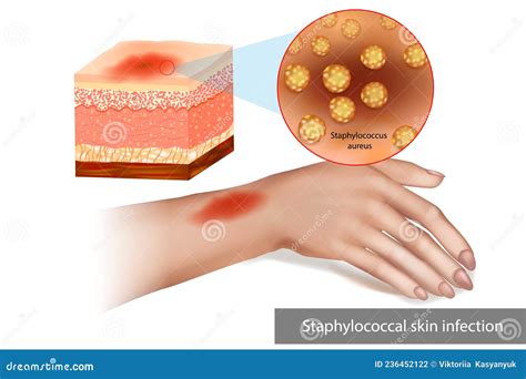 staphylococcal skin infection  staph infection superimposed