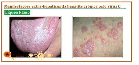 Sintomas Da Hepatite C