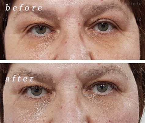 dark circles treatment  laserina clinic manchester trafford
