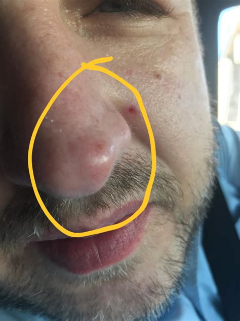 Round red spot/bump on tip of nose that sometimes get brighter red. No